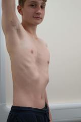 A photo of a young man with his right arm held up showing his deformed ribcage